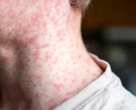 Measles outbreak in West Texas worsens due to low vaccination rates, raising public health concerns