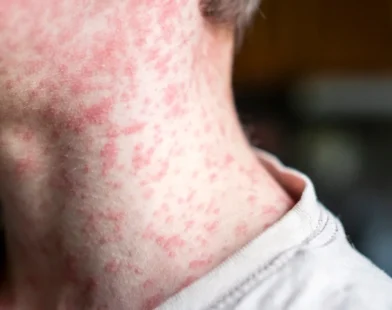 Measles outbreak in West Texas worsens due to low vaccination rates, raising public health concerns