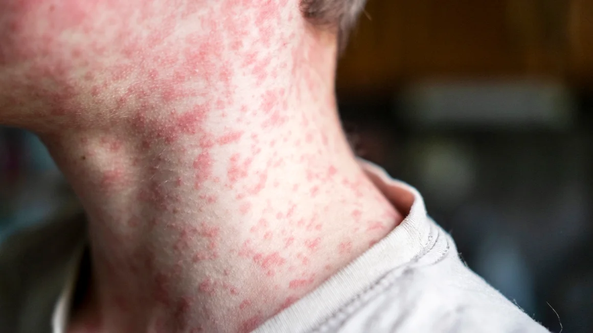 Measles outbreak in West Texas worsens due to low vaccination rates, raising public health concerns